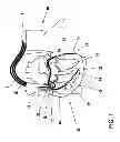 Fig. 02 - Comparison of right-ventricular and left-ventricular contraction using an accelerometer in an artery close to the heart
