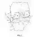 Fig. 02 - Multi-component knee implant assembly with combined articulating and belt support and traveling surfaces