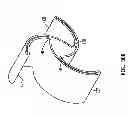 Fig. 22 - Balloon folding technology