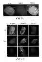 Fig. 03 - Identification of a Genetic Risk Factor for Diabetes