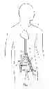 Fig. 02 - Device and method for establishing an artificial arterio-venous fistula