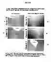 Fig. 02 - PROGNOSTIC TESTS FOR DEVELOPMENT OF DERMAL STRETCH MARKS AND IMPLICATIONS FOR THE PREVENTATIVE TREATMENT THEREOF
