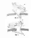 Fig. 09 - Surgical hand access apparatus