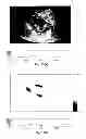 Fig. 22 - SYSTEMS AND METHODS FOR COMPOSITE MYOCARDIAL ELASTOGRAPHY