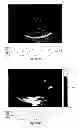 Fig. 28 - SYSTEMS AND METHODS FOR COMPOSITE MYOCARDIAL ELASTOGRAPHY