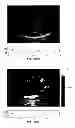 Fig. 32 - SYSTEMS AND METHODS FOR COMPOSITE MYOCARDIAL ELASTOGRAPHY