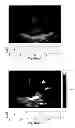 Fig. 33 - SYSTEMS AND METHODS FOR COMPOSITE MYOCARDIAL ELASTOGRAPHY