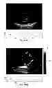 Fig. 35 - SYSTEMS AND METHODS FOR COMPOSITE MYOCARDIAL ELASTOGRAPHY