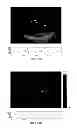 Fig. 45 - SYSTEMS AND METHODS FOR COMPOSITE MYOCARDIAL ELASTOGRAPHY