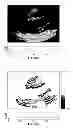Fig. 49 - SYSTEMS AND METHODS FOR COMPOSITE MYOCARDIAL ELASTOGRAPHY