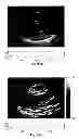 Fig. 52 - SYSTEMS AND METHODS FOR COMPOSITE MYOCARDIAL ELASTOGRAPHY