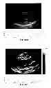 Fig. 53 - SYSTEMS AND METHODS FOR COMPOSITE MYOCARDIAL ELASTOGRAPHY