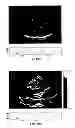 Fig. 63 - SYSTEMS AND METHODS FOR COMPOSITE MYOCARDIAL ELASTOGRAPHY