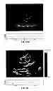 Fig. 64 - SYSTEMS AND METHODS FOR COMPOSITE MYOCARDIAL ELASTOGRAPHY