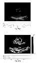 Fig. 65 - SYSTEMS AND METHODS FOR COMPOSITE MYOCARDIAL ELASTOGRAPHY