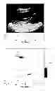 Fig. 83 - SYSTEMS AND METHODS FOR COMPOSITE MYOCARDIAL ELASTOGRAPHY