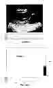 Fig. 85 - SYSTEMS AND METHODS FOR COMPOSITE MYOCARDIAL ELASTOGRAPHY