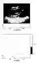 Fig. 86 - SYSTEMS AND METHODS FOR COMPOSITE MYOCARDIAL ELASTOGRAPHY