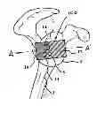 Fig. 01 - ORTHOPAEDIC INSTRUMENT