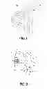 Fig. 02 - Positioning insert for intervertebral disc disorder