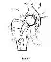 Fig. 02 - Coated implants and related methods