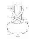Fig. 22 - Implantable prosthetic device for distribution of weight on amputated limb and method of use with an external prosthetic device