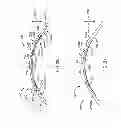 Fig. 23 - Eye covering and refractive correction methods and apparatus having improved tear flow, comfort, and/or applicability