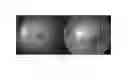 Fig. 02 - Normalization of retinal nerve fiber layer thickness measurements made by time domain-optical coherence tomography