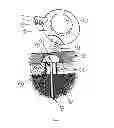 Fig. 02 - Method of draining autologous bodily fluid into intraosseus space