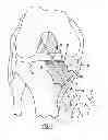 Fig. 08 - Method and apparatus for forming a hole in bone during a surgical procedure