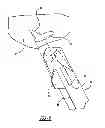 Fig. 09 - Method and apparatus for forming a hole in bone during a surgical procedure