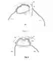 Fig. 07 - Knotted suture end effector