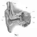 Fig. 02 - Accelerated fitting of ear implants