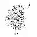 Fig. 08 - Adjustable spine distraction implant