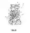 Fig. 09 - Adjustable spine distraction implant