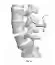 Fig. 23 - Adjustable spine distraction implant