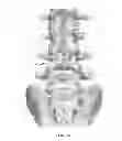 Fig. 24 - Adjustable spine distraction implant