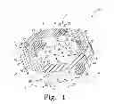 Fig. 02 - Radially expandable spinal interbody device and implantation tool