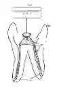 Fig. 01 - Pressure Wave Root Canal Cleaning System