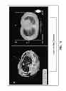 Fig. 22 - SYSTEMS AND METHODS FOR PLANNING IMAGE GUIDED INTERVENTIONAL PROCEDURES