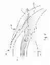 Fig. 03 - Systems and methods for disruption of an eye lens