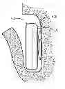 Fig. 01 - Apparatus and method for implanting and securing the position of implantable medical device