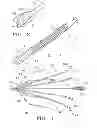 Fig. 03 - Non-entangling vena cava filter