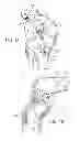 Fig. 02 - Attachment device to attach tissue graft