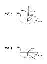 Fig. 05 - KNOTLESS SUTURE ANCHOR