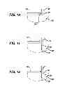 Fig. 06 - KNOTLESS SUTURE ANCHOR