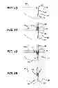 Fig. 07 - KNOTLESS SUTURE ANCHOR