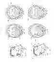 Fig. 16 - Devices and methods for sleep apnea treatment