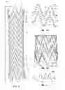 Fig. 02 - Electrospun PTFE coated stent and method of use