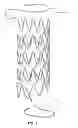 Fig. 05 - Electrospun PTFE coated stent and method of use